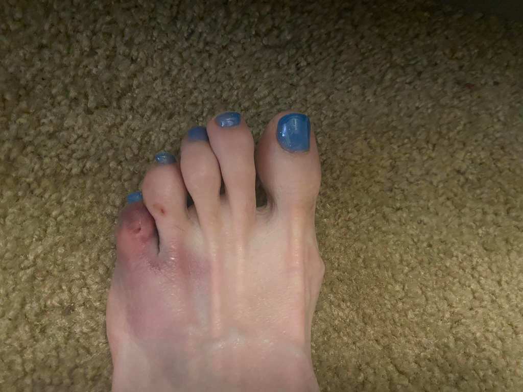 A severely bruised foot