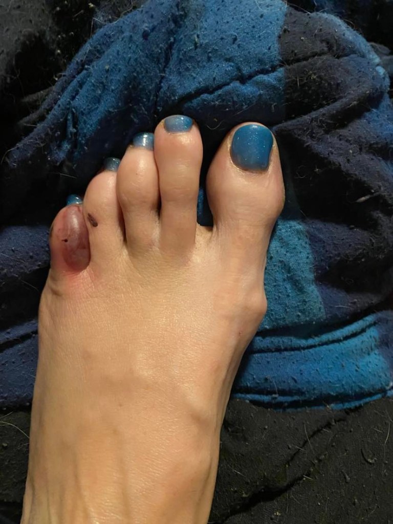 A toe with blisters